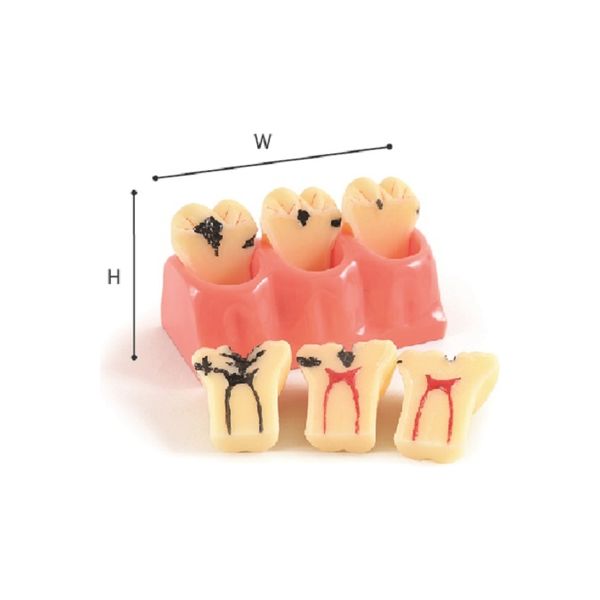 カリエス臼歯用モデル 1011 1個 プレミアムプラスジャパン（取寄品）