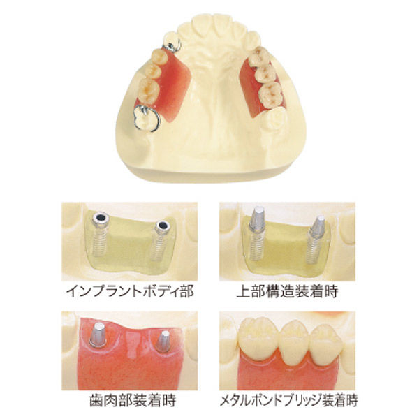 Amazon.co.jp: スタンダードパーシャルデンチャー補綴学 (第4版