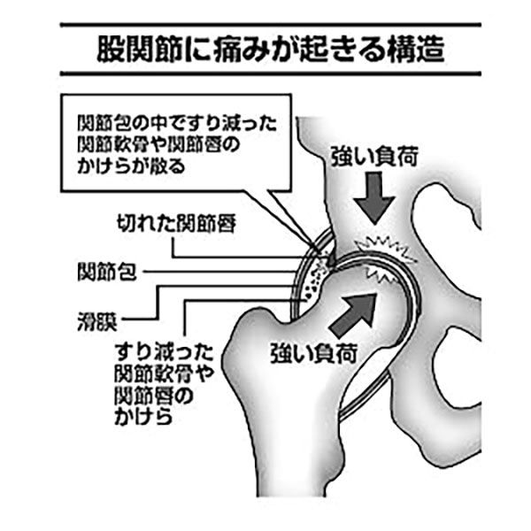 文響社 股関節痛 変形性股関節症 整形外科の名医が教える 最高の治し方