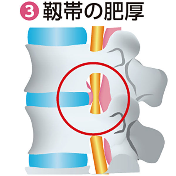 脊柱管狭窄症は自分で治せる! - 健康・医学