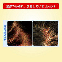 メンソレータム メディクイックHゴールド 30ml ロート製薬　塗り薬 頭皮湿疹 皮フ炎 かゆみ かぶれ【指定第2類医薬品】