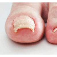 コジット 巻爪ケア プロサポートシール 医療用テープ 80枚入 1個(80枚入)（直送品）